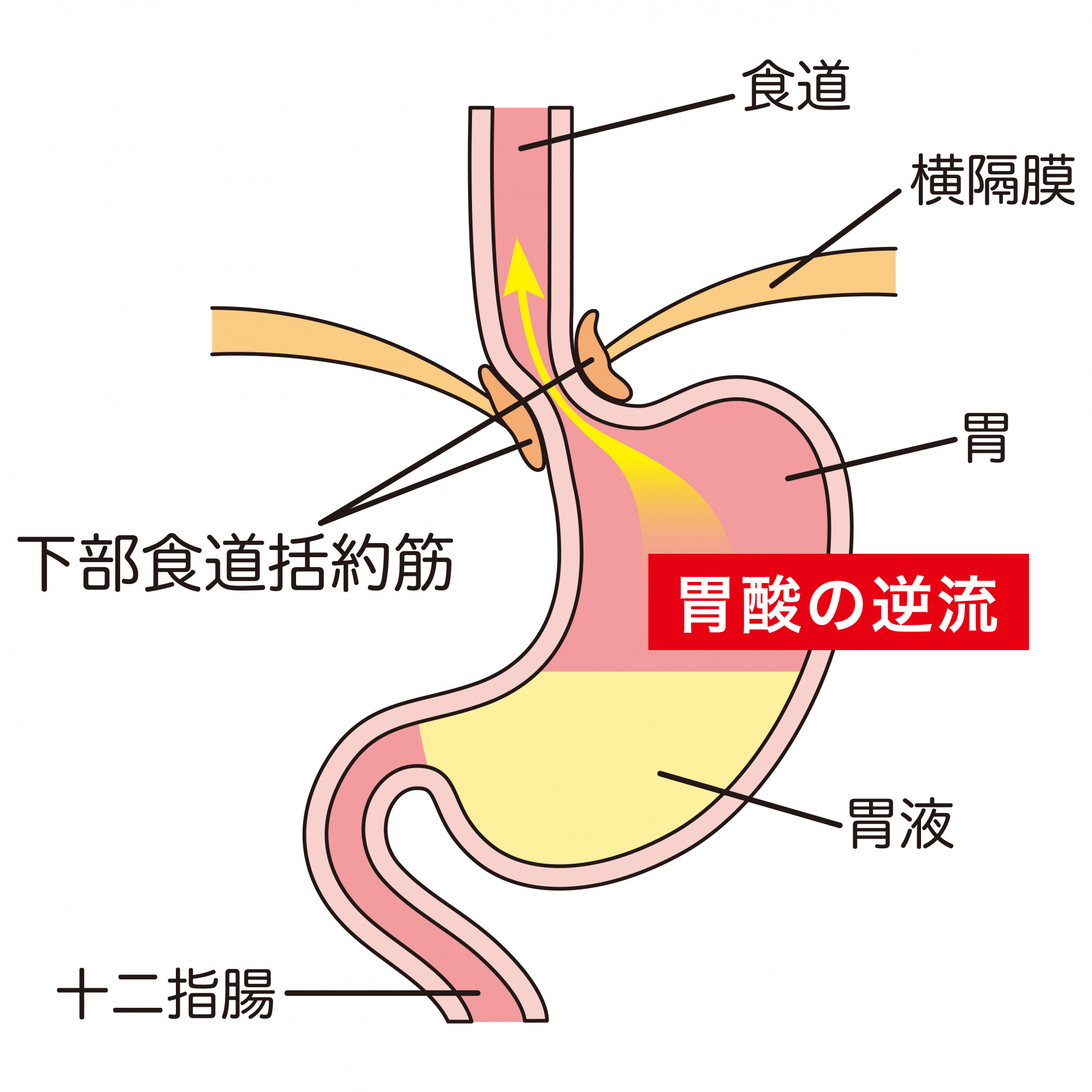 胃酸の逆流のイメージイラスト